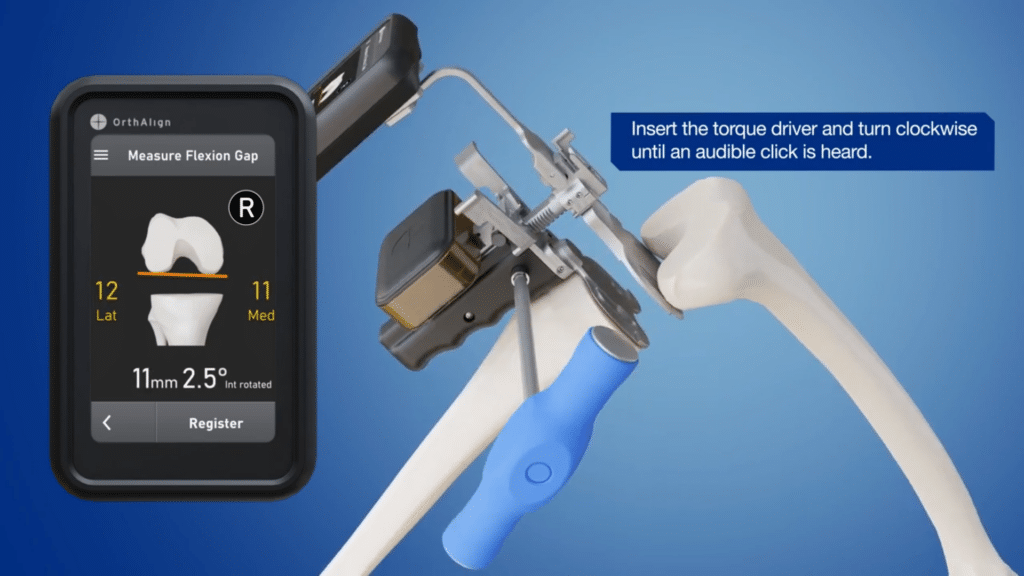 Computer Assisted Surgery Lantern OrthAlign